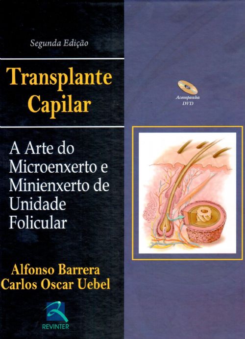 Transplante Capilar - A Arte Do Microenxerto