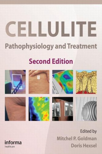 Cellulite: Pathophysiology And Treatment