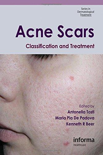 Acne Scars: Classification And Treatment