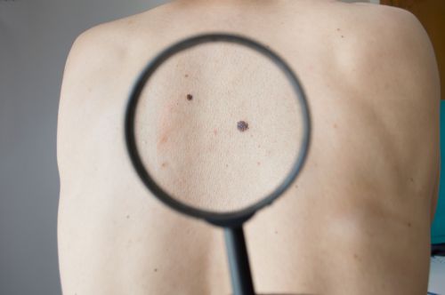 The evolution of skin cancer