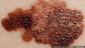 Doctors warn of rise in young patients with skin cancer