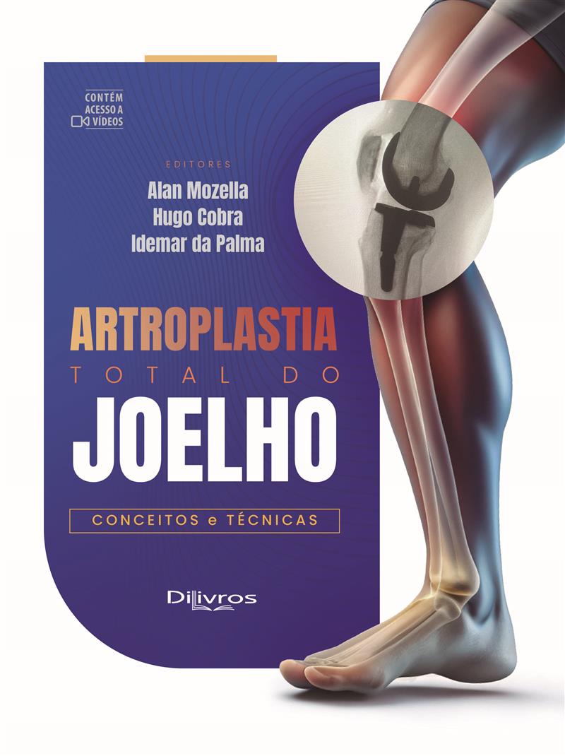 Artroplastia Total Do Joelho Conceitos E Tecnicas