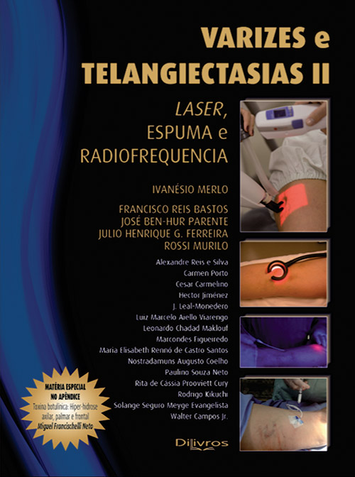 Varizes E Telangiectasias Ii  Laser Espuma E Radiofrequencia