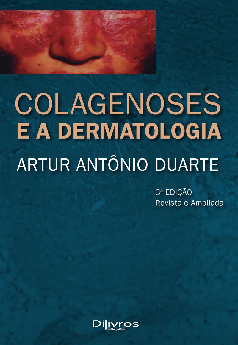 Colagenoses E A Dermatologia